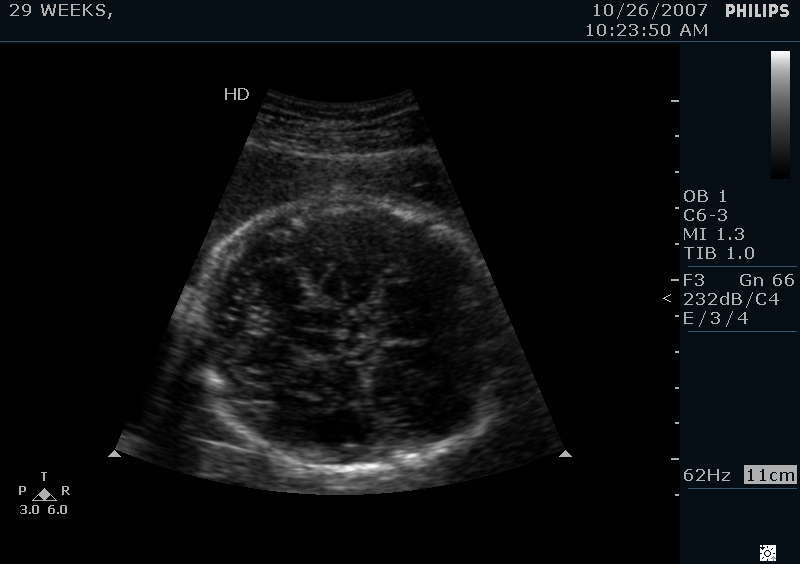29 Weeks Ultrasound