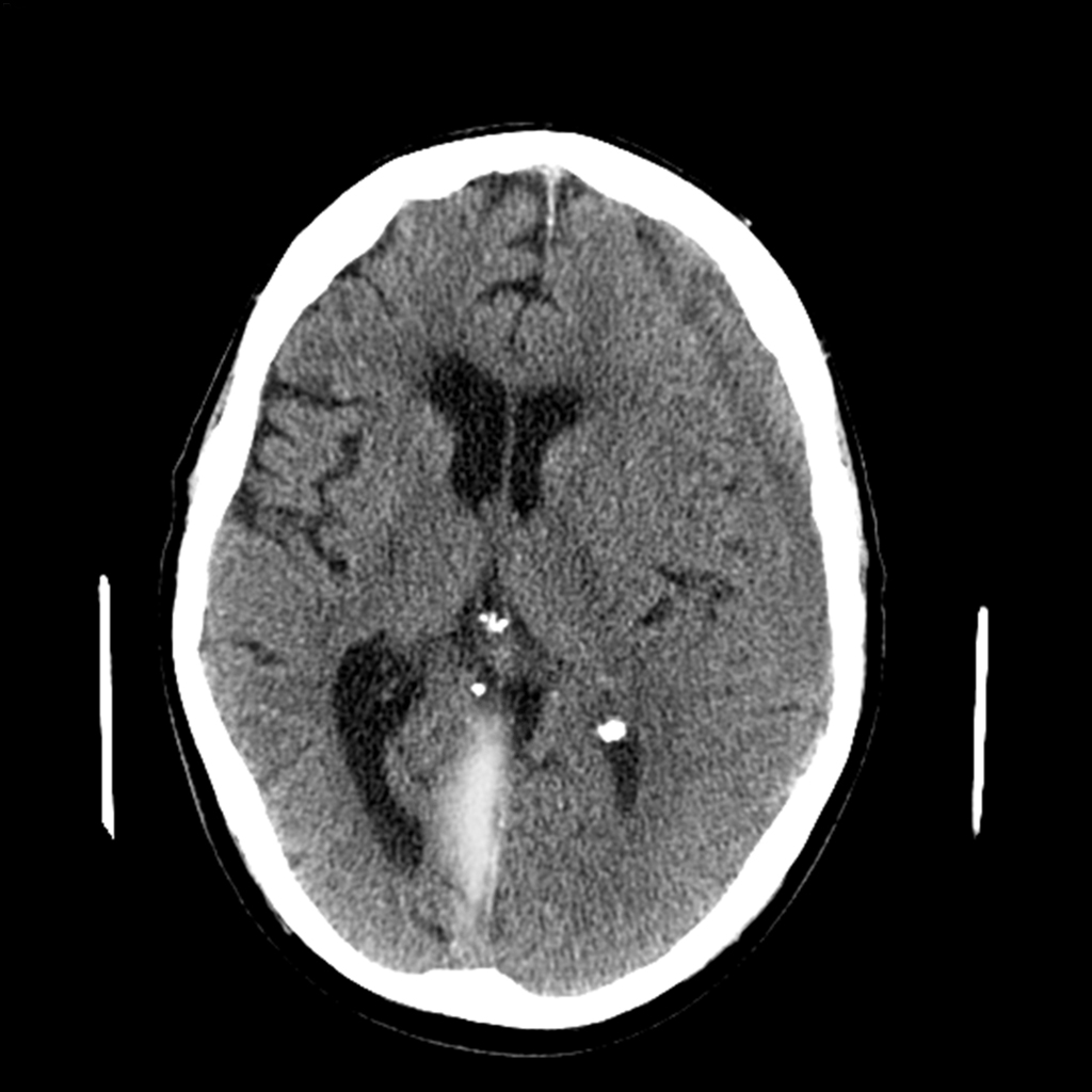 CT Brain Scan