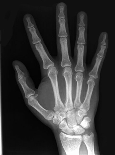 Hand & Wrist X Ray