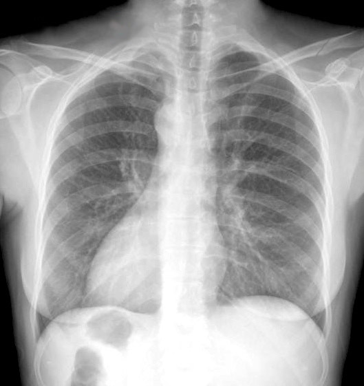 Female Chest X Ray